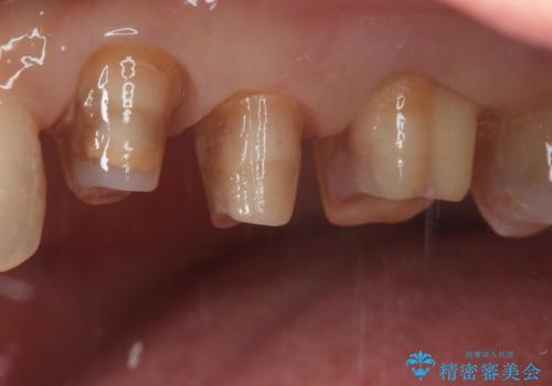 【オールセラミッククラウン】銀歯の下に大きな虫歯の治療中