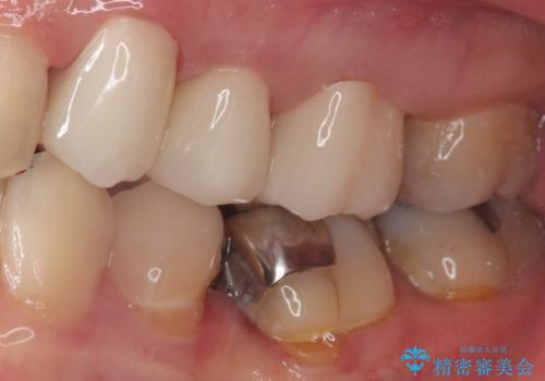 【オールセラミッククラウン】銀歯の下に大きな虫歯の治療後