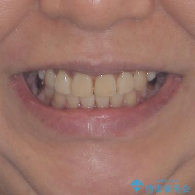クロスバイトの前歯を治したい ワイヤー装置でも抜歯矯正の治療後(顔貌)