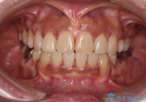 クロスバイトの前歯を治したい ワイヤー装置でも抜歯矯正の症例 治療後