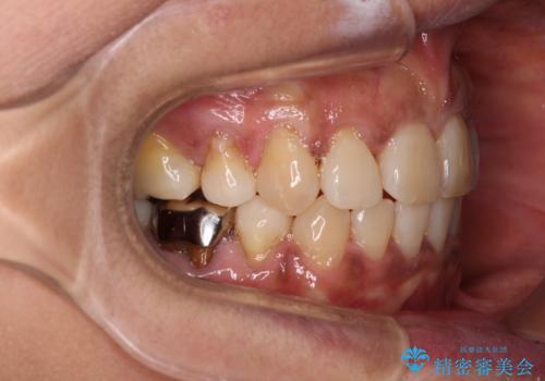 クロスバイトの前歯を治したい ワイヤー装置でも抜歯矯正の治療後