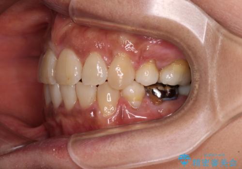クロスバイトの前歯を治したい　ワイヤー装置でも抜歯矯正の治療後