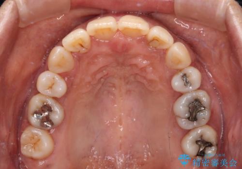 クロスバイトの前歯を治したい ワイヤー装置でも抜歯矯正の治療後