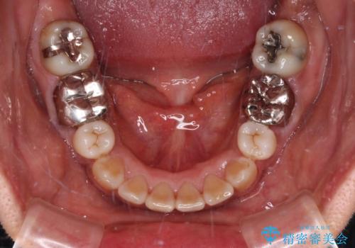 奥歯の銀歯をゴールドに　の治療前