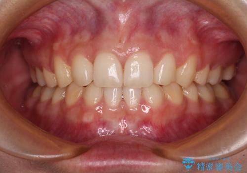 【モニター】下顎前歯の2本欠損　上顎のみの抜歯でバランスを取ったワイヤー矯正の症例 治療後