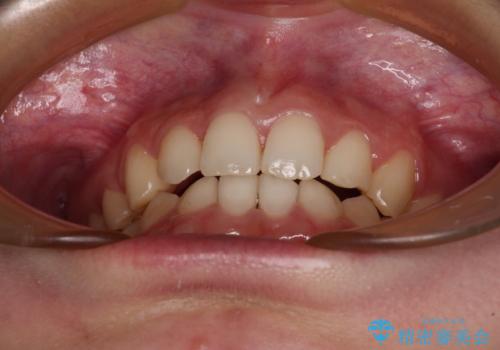 【モニター】下顎前歯の2本欠損　上顎のみの抜歯でバランスを取ったワイヤー矯正の治療後