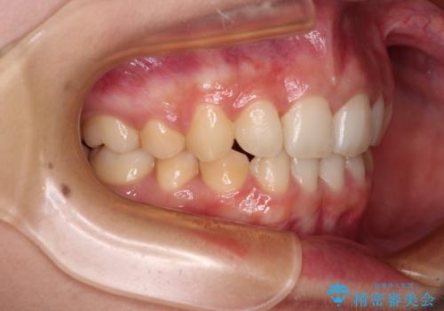 【モニター】下顎前歯の2本欠損　上顎のみの抜歯でバランスを取ったワイヤー矯正の治療後