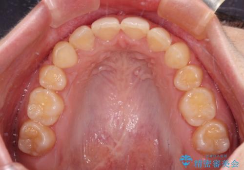 【モニター】下顎前歯の2本欠損　上顎のみの抜歯でバランスを取ったワイヤー矯正の治療後
