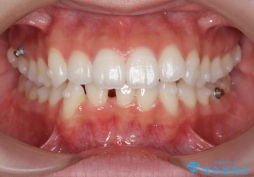 歯を抜かずに後方移動で達成する、前突感の改善の治療中