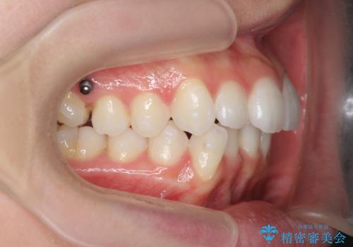 歯を抜かずに後方移動で達成する、前突感の改善の治療中