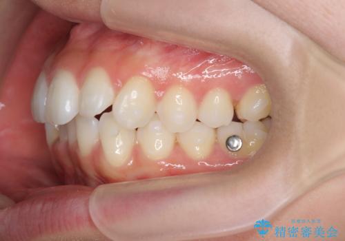 歯を抜かずに後方移動で達成する、前突感の改善の治療中