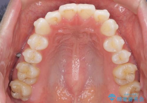歯を抜かずに後方移動で達成する、前突感の改善の治療中