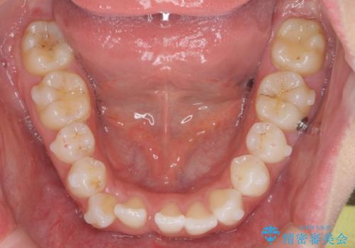 歯を抜かずに後方移動で達成する、前突感の改善の治療中