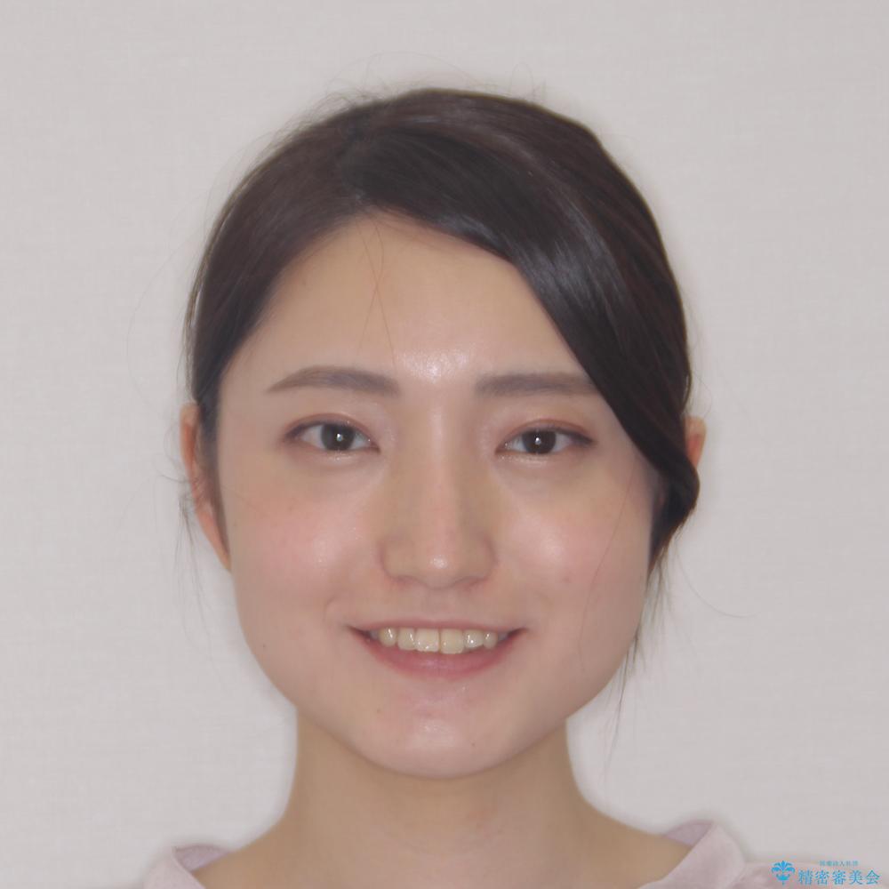 【モニター】捻れた前歯をスッキリと インビザライン矯正治療の治療前(顔貌)