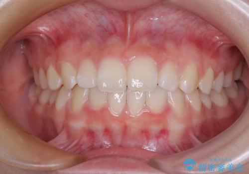 前歯のデコボコを治したい 高校生のインビザライン治療の症例 治療後