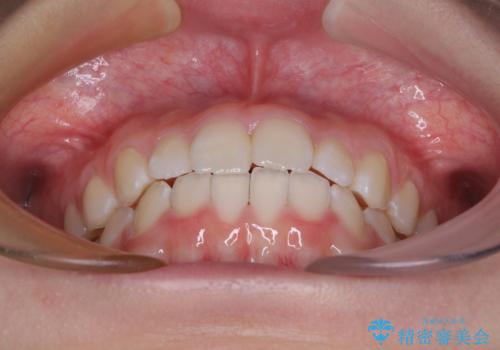 前歯のデコボコを治したい 高校生のインビザライン治療の治療後