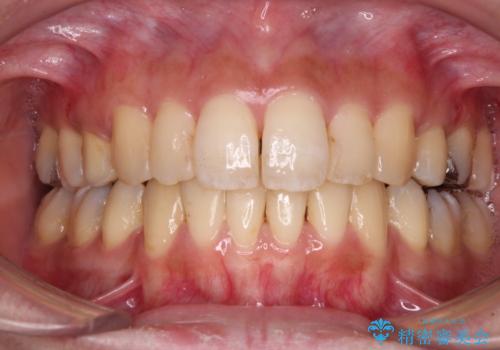 後戻りで突出した前歯をインビザラインで解消の治療中