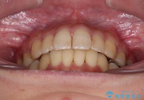 後戻りで突出した前歯をインビザラインで解消の治療中