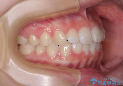 前歯のデコボコを治したい 高校生のインビザライン治療の治療後