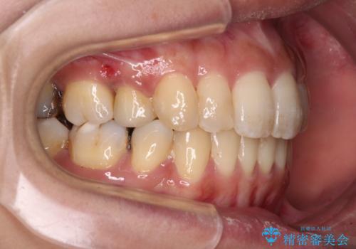後戻りで突出した前歯をインビザラインで解消の治療中