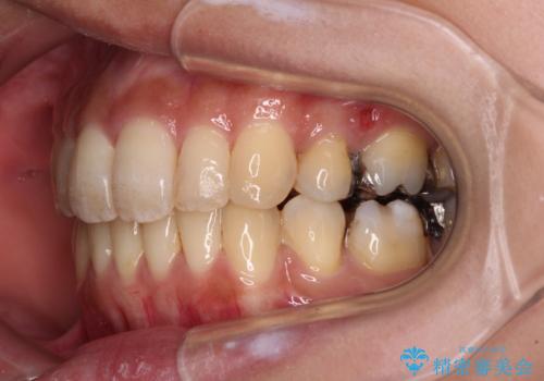 後戻りで突出した前歯をインビザラインで解消の治療中