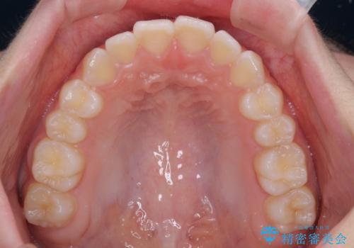 前歯のデコボコを治したい 高校生のインビザライン治療の治療後