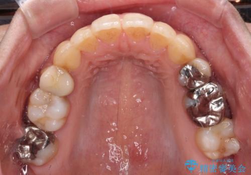 後戻りで突出した前歯をインビザラインで解消の治療中