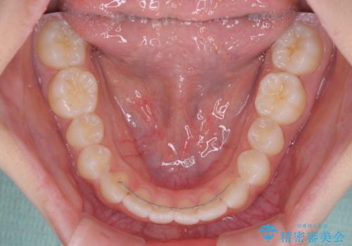 前歯のデコボコを治したい 高校生のインビザライン治療の治療後