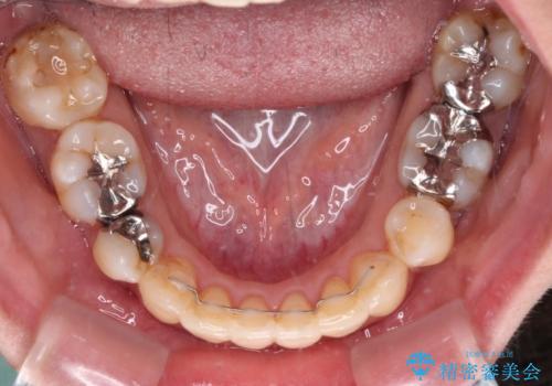 後戻りで突出した前歯をインビザラインで解消の治療中