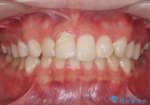出っ歯が気になる　歯をぬかずに治療の症例 治療前