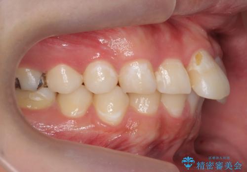 出っ歯が気になる　歯をぬかずに治療の治療前