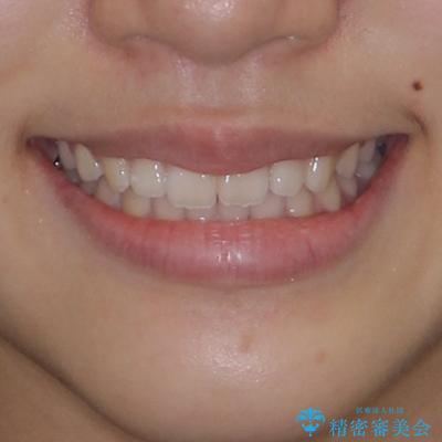 前歯のデコボコを治したい 高校生のインビザライン治療の治療後(顔貌)