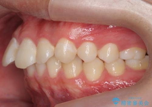出っ歯が気になる 歯をぬかずに治療の治療前