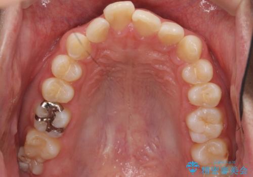 出っ歯が気になる 歯をぬかずに治療の治療前