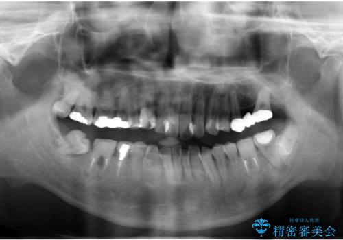 短期間で歯並びをきれいにしたい セラミックでかぶせる治療でも良いの治療前