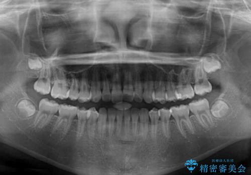 前歯のデコボコを治したい 高校生のインビザライン治療の治療前
