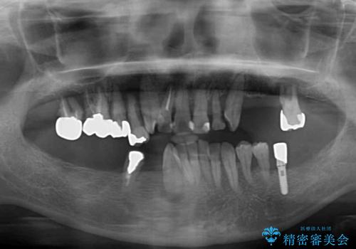 歯周病で痛い 全顎的歯周病治療の治療前