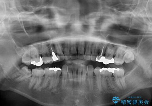 後戻りで突出した前歯をインビザラインで解消の治療前