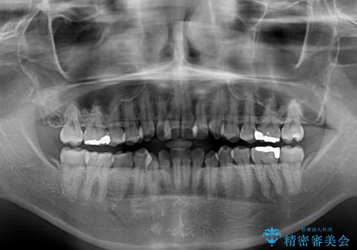 舌突出癖による開咬 舌のトレーニングを行いながら咬み合わせを改善の治療前