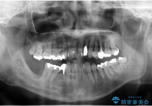 受け口 なんと部分矯正で治るんです!! インプラントを含めた総合歯科治療の治療前