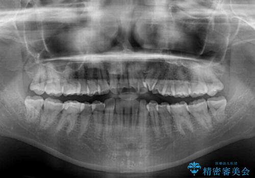 【モニター】1本欠損した下顎前歯と上顎の八重歯 ワイヤー装置で楽して矯正治療の治療前