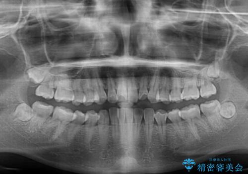 【モニター】捻れた前歯をスッキリと インビザライン矯正治療の治療前