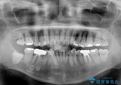 クロスバイトの前歯を治したい ワイヤー装置でも抜歯矯正の治療前