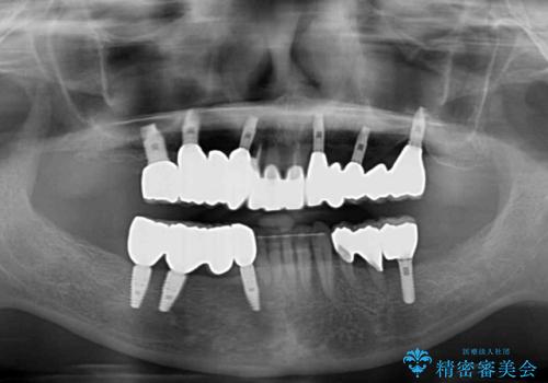 歯周病で痛い 全顎的歯周病治療の治療後