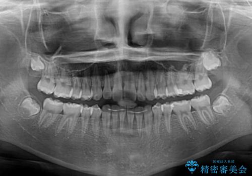 前歯のデコボコを治したい 高校生のインビザライン治療の治療後