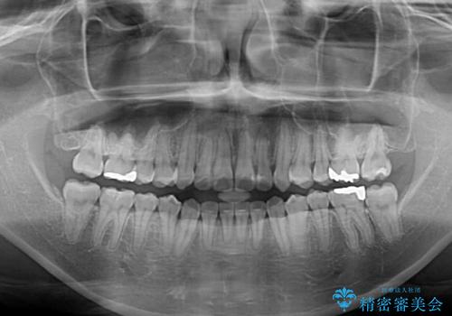 舌突出癖による開咬 舌のトレーニングを行いながら咬み合わせを改善の治療後