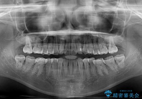 【モニター】1本欠損した下顎前歯と上顎の八重歯 ワイヤー装置で楽して矯正治療の治療後