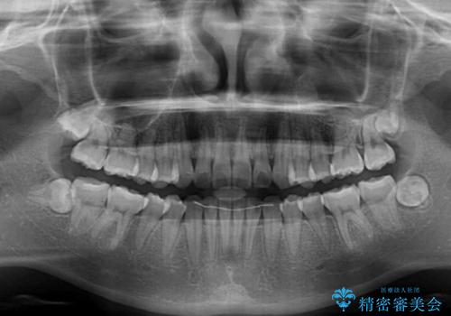 【モニター】捻れた前歯をスッキリと インビザライン矯正治療の治療後