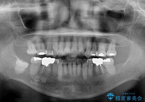クロスバイトの前歯を治したい　ワイヤー装置でも抜歯矯正の治療後