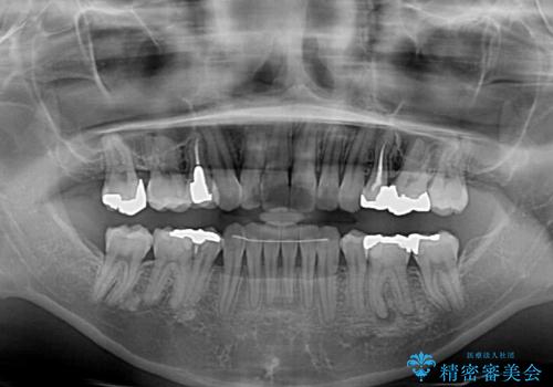 後戻りで突出した前歯をインビザラインで解消の治療後